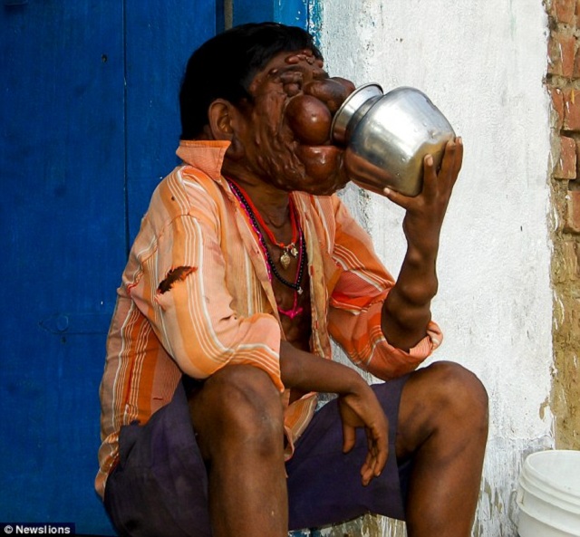 boy with tumors